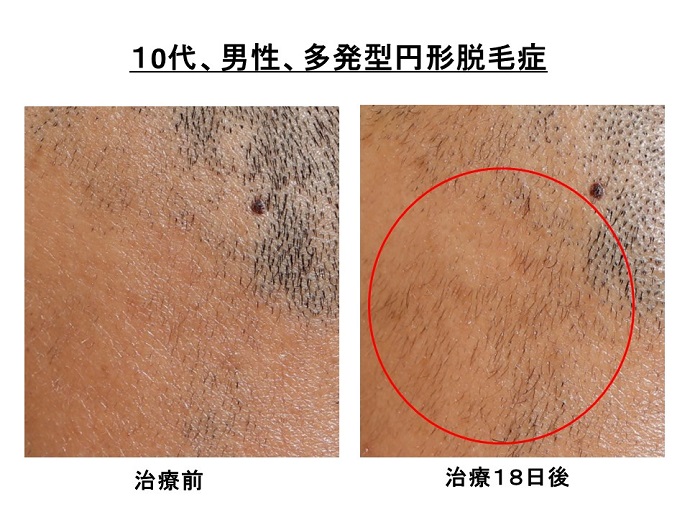 円形脱毛症　病院